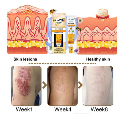 ZVLZVL® Bee Venom Mole and Wart Treatment Cream (👨‍⚕AAD RECOMMENDS)