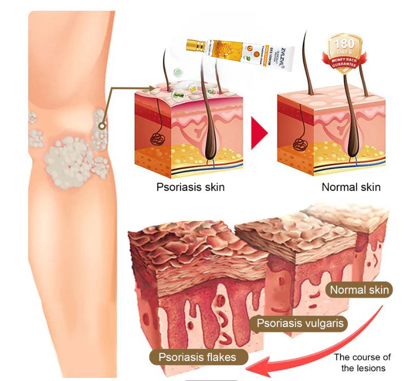 ZVLZVL® Bee Venom Mole and Wart Treatment Cream (👨‍⚕AAD RECOMMENDS)