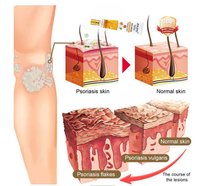 ZVLZVL® Bee Venom Mole and Wart Treatment Cream (👨‍⚕AAD RECOMMENDS)